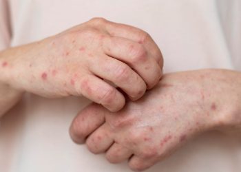 SARAMPIÓN-NUEVO-LEÓN